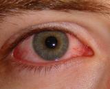 por-que-os-olhos-ficam-vermelhos-quando-temos-sono.jpg